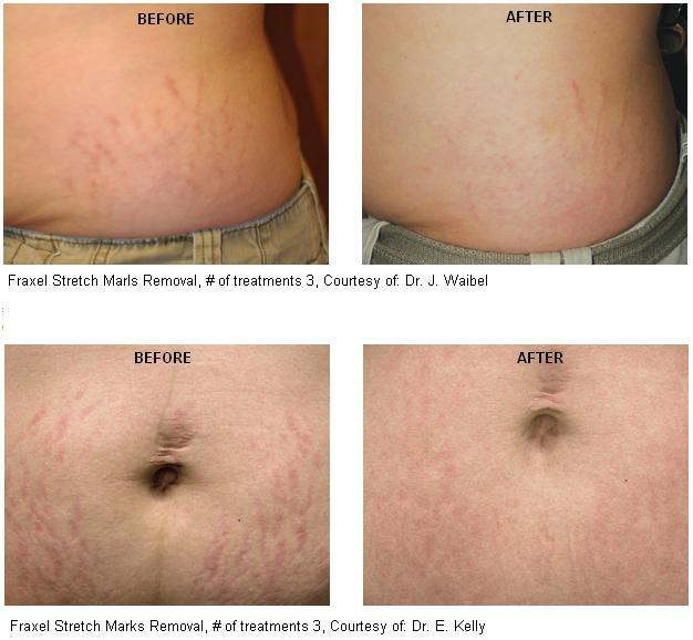 Top 93 Pictures Laser Treatments For Stretch Marks Before And After Pictures Superb