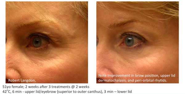 skin tightening treatments 6 Dermatology Skin Tightening, Face  Advanced NYC  ThermiSmooth