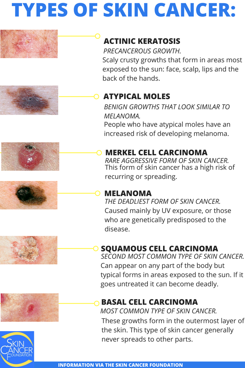 Spelling Out Skin Cancer | Advanced Dermatology Blog - Dermatologists ...