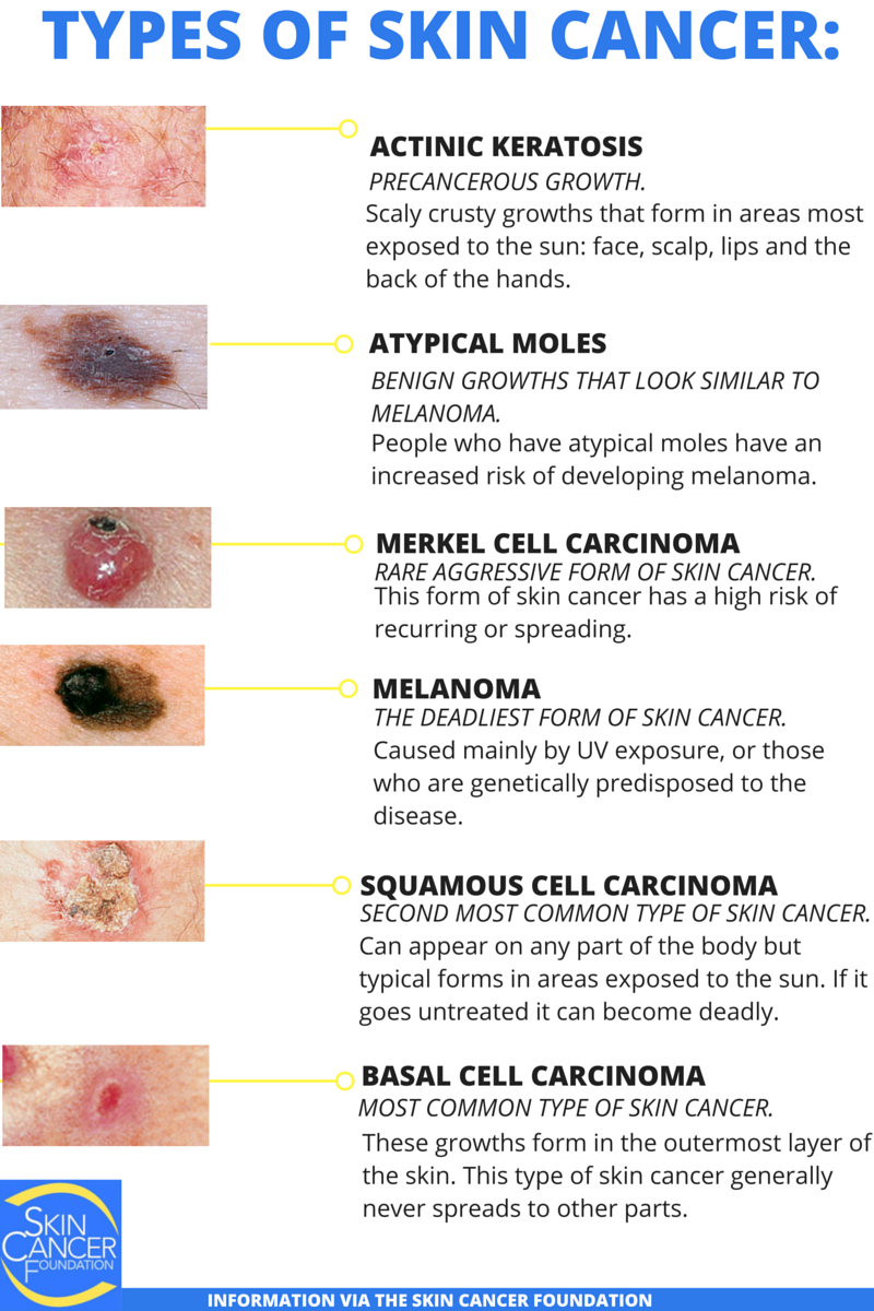 Signs Are Skin Cancer At Michael Splawn Blog