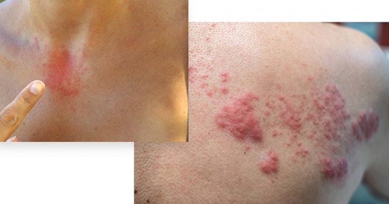 Hives Advanced Dermatology Pc