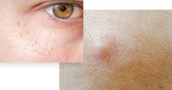 Moles/Growths/Bumps | Advanced Dermatology, P.C.