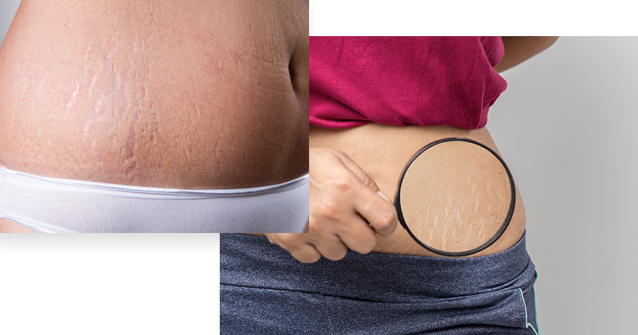 Tummy Tuck in Westchester, Long Island, & New York City (NYC)