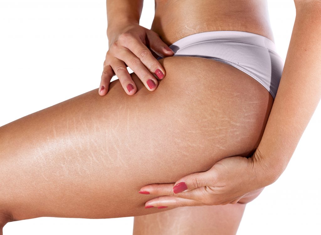 Uncovering Stretch Marks: Your Questions, Answered - Axia Women's Health