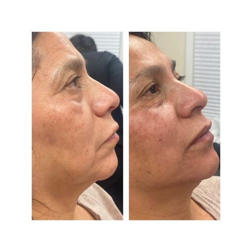 Jawline enhancement, ulthera plus injectables