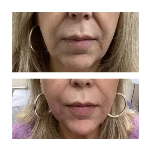 Injectable/liquid facelift/nonsurgical facelift