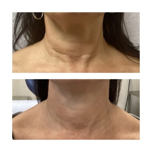 Sofwave neck firming plus botox treatment