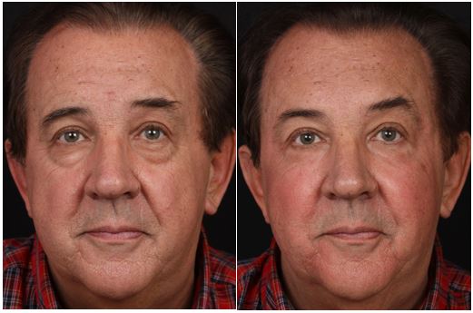 Male face, before and after Restylane treatment, front view, patient 1